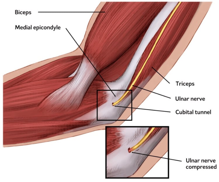 Illustration of the ulnar nerve passing through the cubital tunnel behind the medial epicondyle