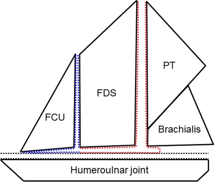 Schematic of the medial elbow dynamic stabilising complex formed by flexor-pronator septa, capsule and UCL