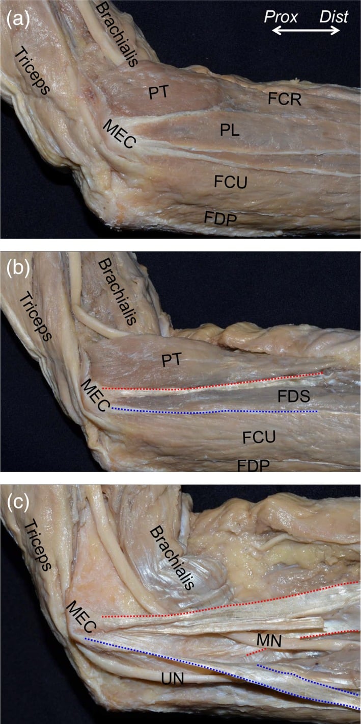Layered medial elbow dissections showing the flexor-pronator muscles and tendinous septa