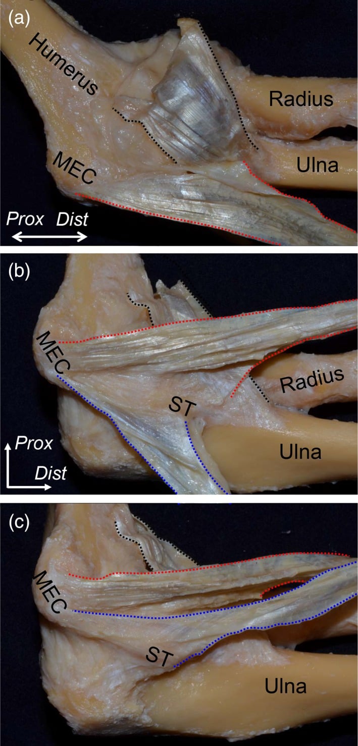 Medial elbow dissections showing the pronator teres and flexor digitorum superficialis tendinous septum