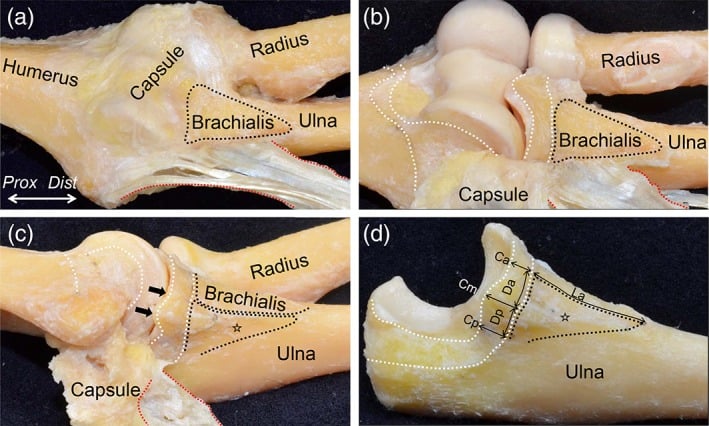 Dissection showing the flexor-pronator tendinous complex, capsule and sublime tubercle attachments