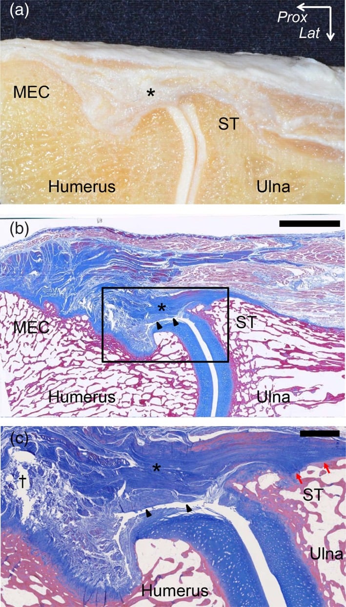 Oblique coronal histology of the pronator teres and flexor digitorum superficialis septum beside the UCL