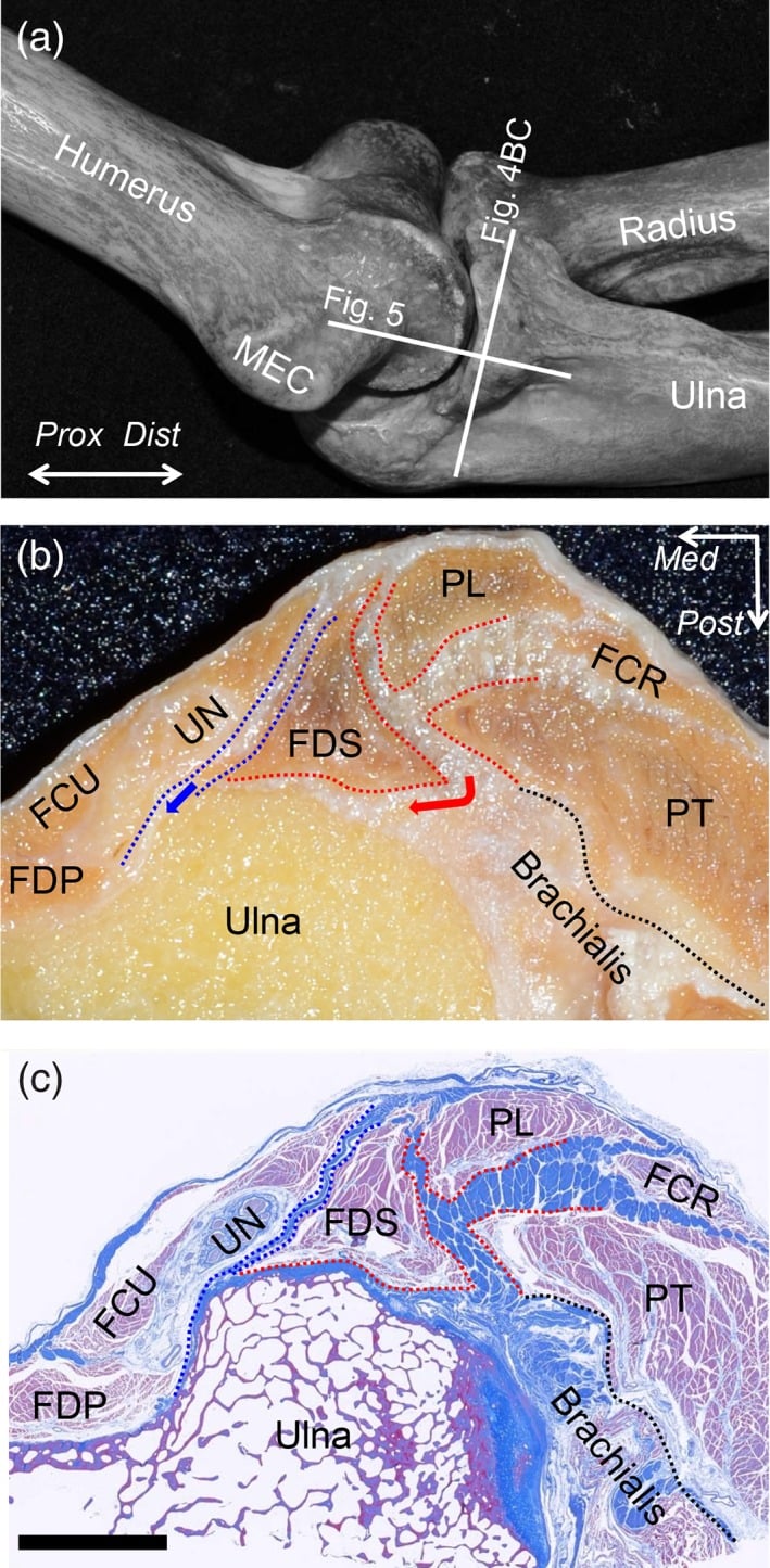 Axial histology at the sublime tubercle showing continuity of flexor-pronator septum, capsule and UCL