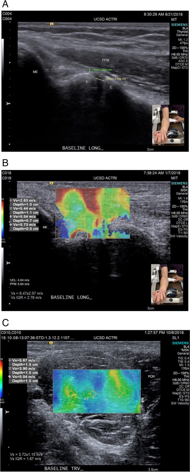 Ultrasound and shear-wave elastography of the ulnar collateral ligament and flexor-pronator mass at the medial elbow