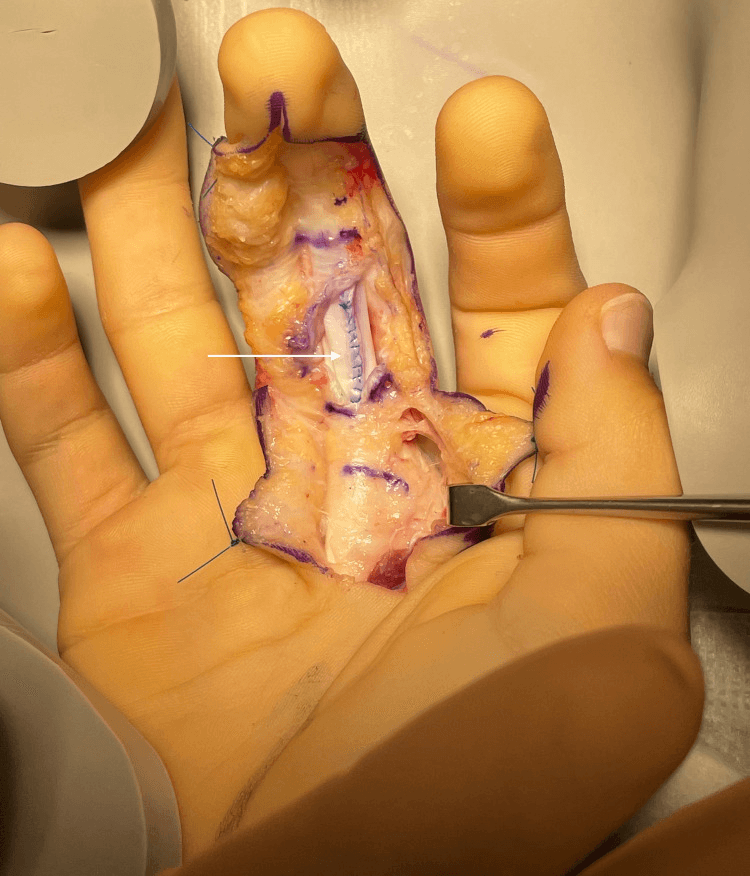 Operative close-up of repaired FDP tendon with visible suture line