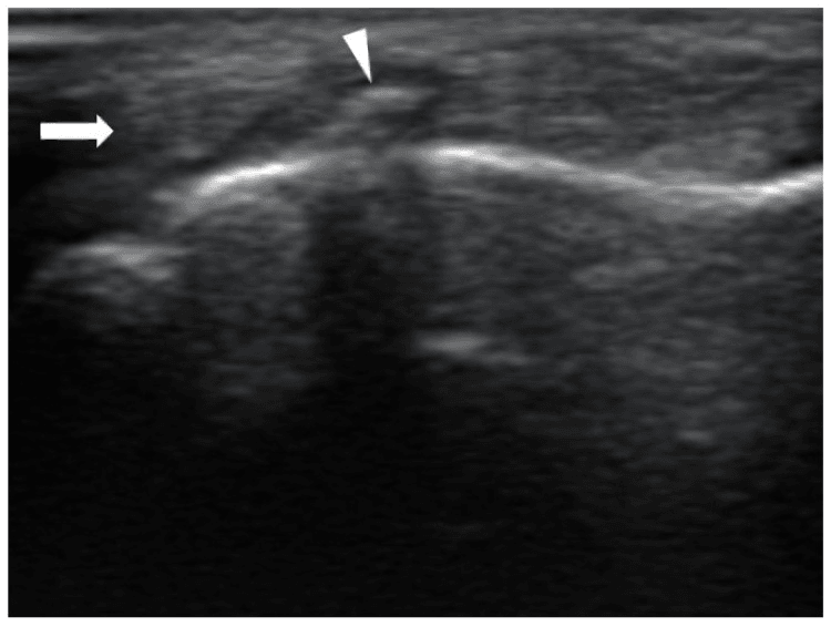 Longitudinal ultrasound showing a bone spike incarcerating the flexor tendon