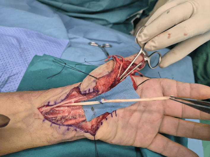 Operative close-up of completed FPL sliding autograft reconstruction
