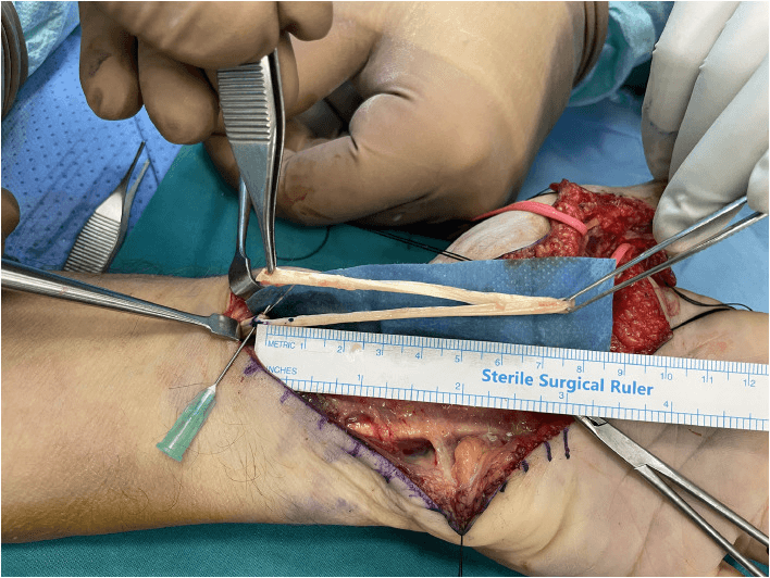 Operative close-up showing creation of a sliding FPL autograft