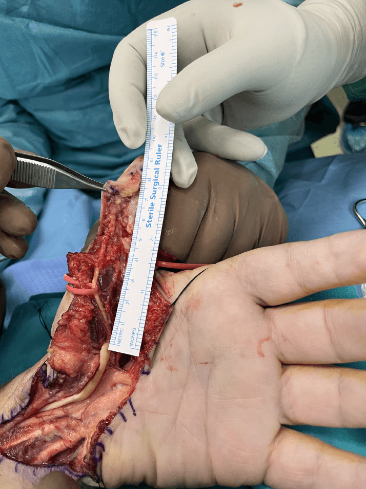 Operative close-up measuring a Zone 1 FPL tendon gap