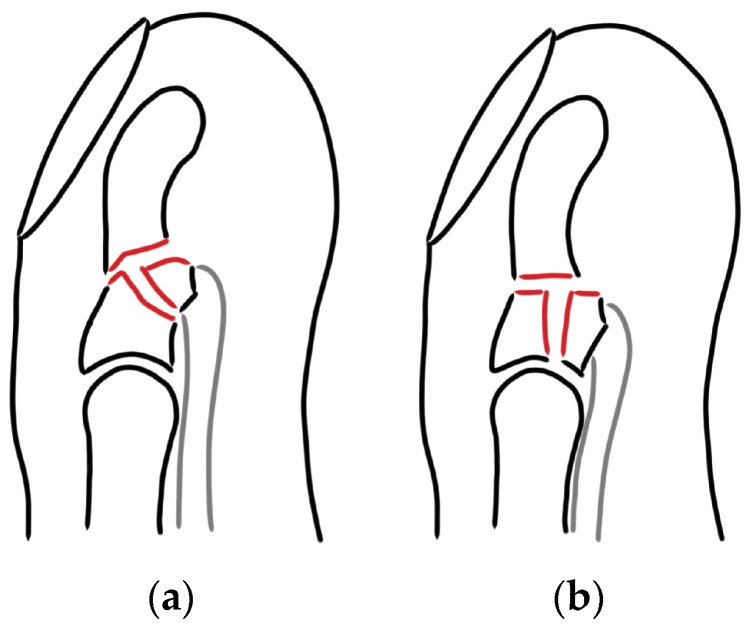 Schematic comparing Type Va and Type Vb jersey-finger injuries