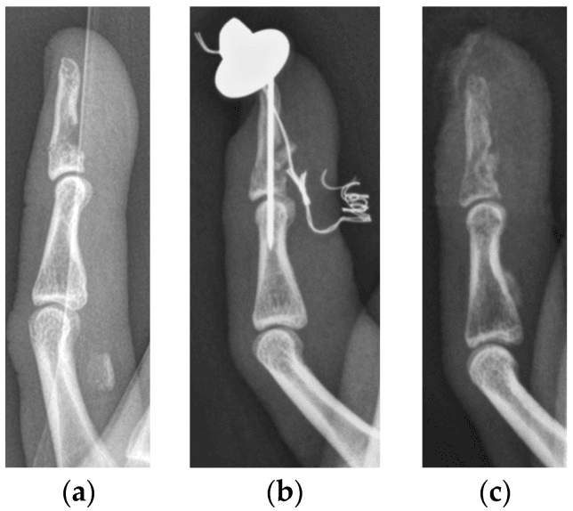 Serial lateral radiographs of Type Va jersey finger with FDP retraction and fixation