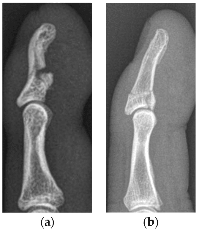 Lateral finger radiographs showing Type Va and Vb jersey-finger avulsions