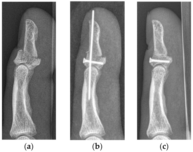 Serial lateral radiographs of displaced Type Vb jersey finger before and after screw and K-wire fixation, and after K-wire removal with the screw retained