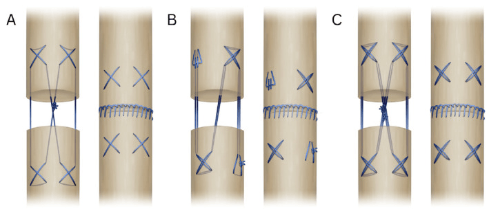 Schematic of three multistrand flexor tendon core-suture configurations, each shown with and without a running epitendinous suture