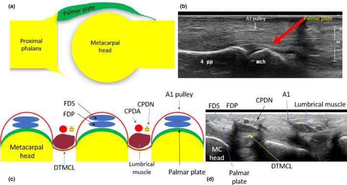 Diagram and ultrasound showing FDS FDP A1 pulley and palmar plate anatomy