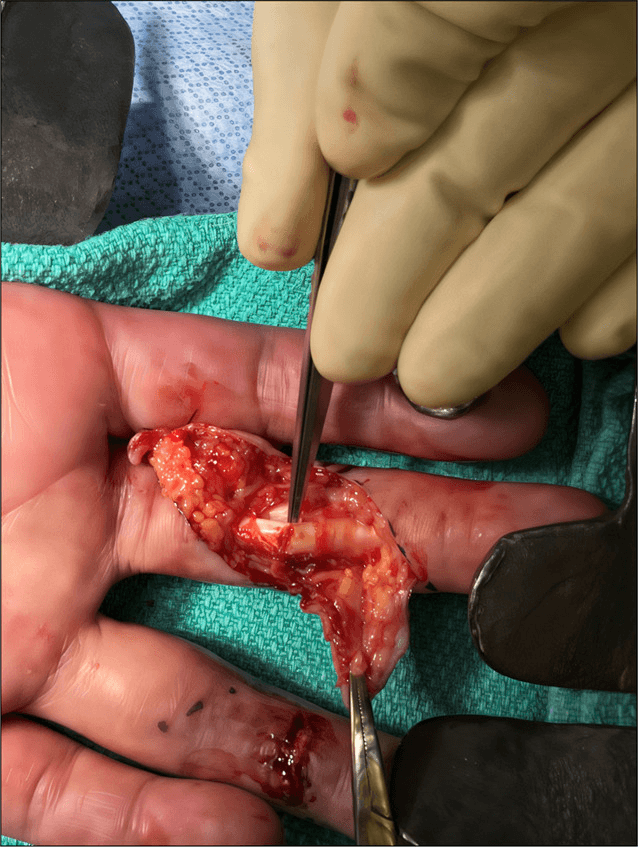 Operative close-up showing a 40 percent partial FDP tendon laceration