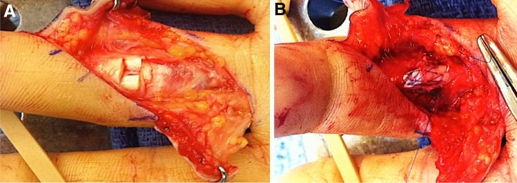 Operative photographs before and after six-strand Lim-Tsai flexor tendon repair