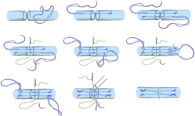 Diagram of the six-strand Lim-Tsai flexor tendon repair