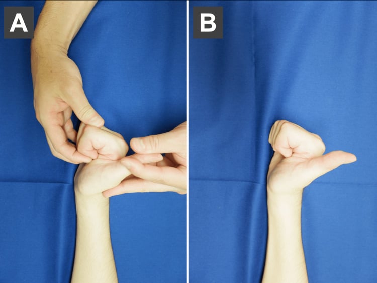 Place-and-hold exercise in two panels: A, the digits placed into a fist by another hand; B, the fist held unaided