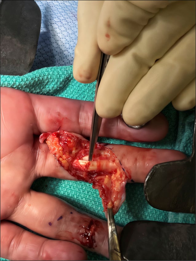 Intraoperative photograph of a partial FDP laceration