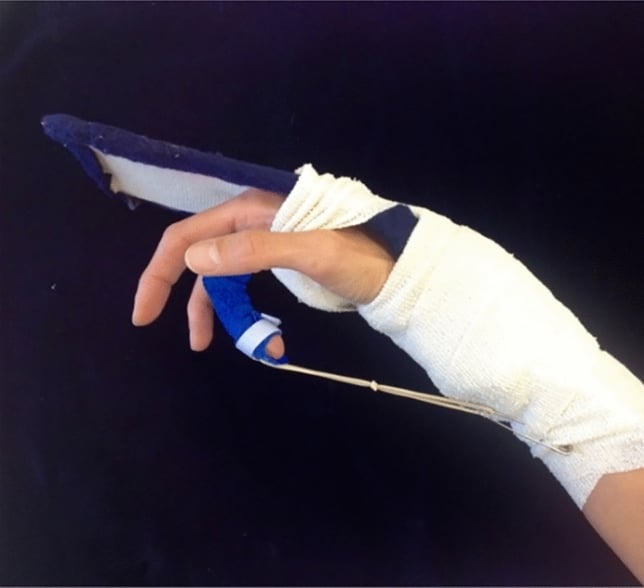 Modified Kleinert/Duran protocol splint configuration