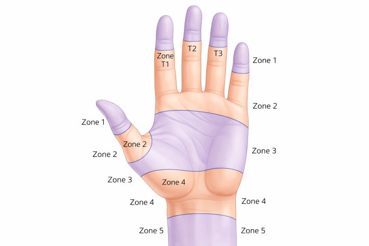 Illustration of flexor tendon zonal anatomy of the hand and wrist (Verdan zones)