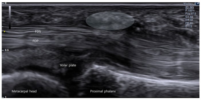 Ultrasound image demonstrating flexor tendon and A1 pulley relationship