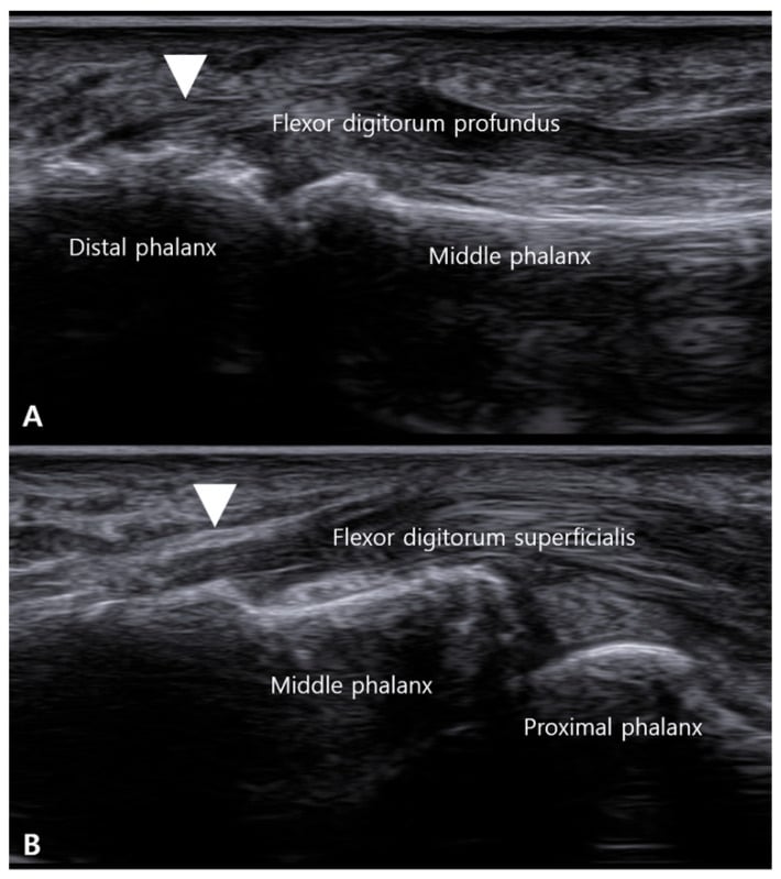 Long-axis ultrasound demonstrating FDP tendon insertion at the distal phalanx