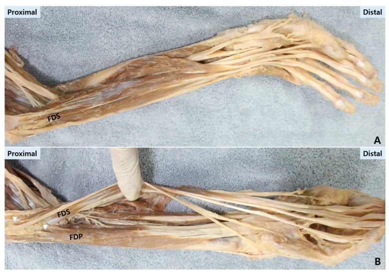 Cadaveric dissection demonstrating FDS and FDP tendons and Camper's chiasm