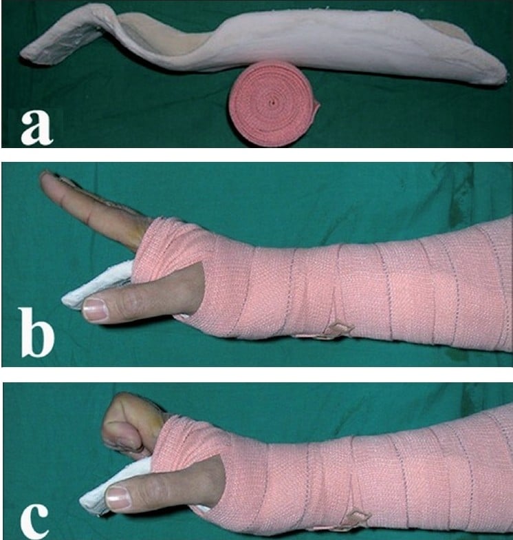 Photographs of postoperative flexor tendon rehabilitation splinting and exercises