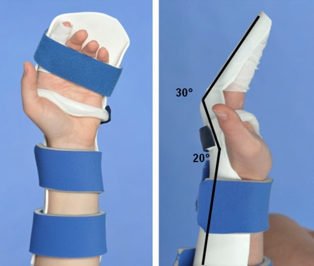 Photographs of a dorsal blocking splint used in controlled active motion flexor tendon rehabilitation