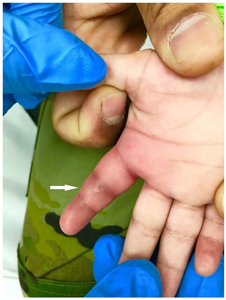 Clinical photograph of infant finger with pyogenic flexor tenosynovitis showing Kanavel signs