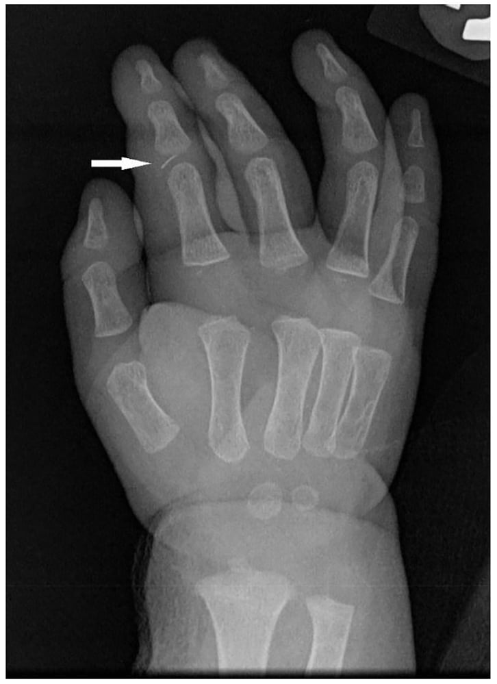Radiograph of pediatric hand showing foreign body causing flexor tenosynovitis