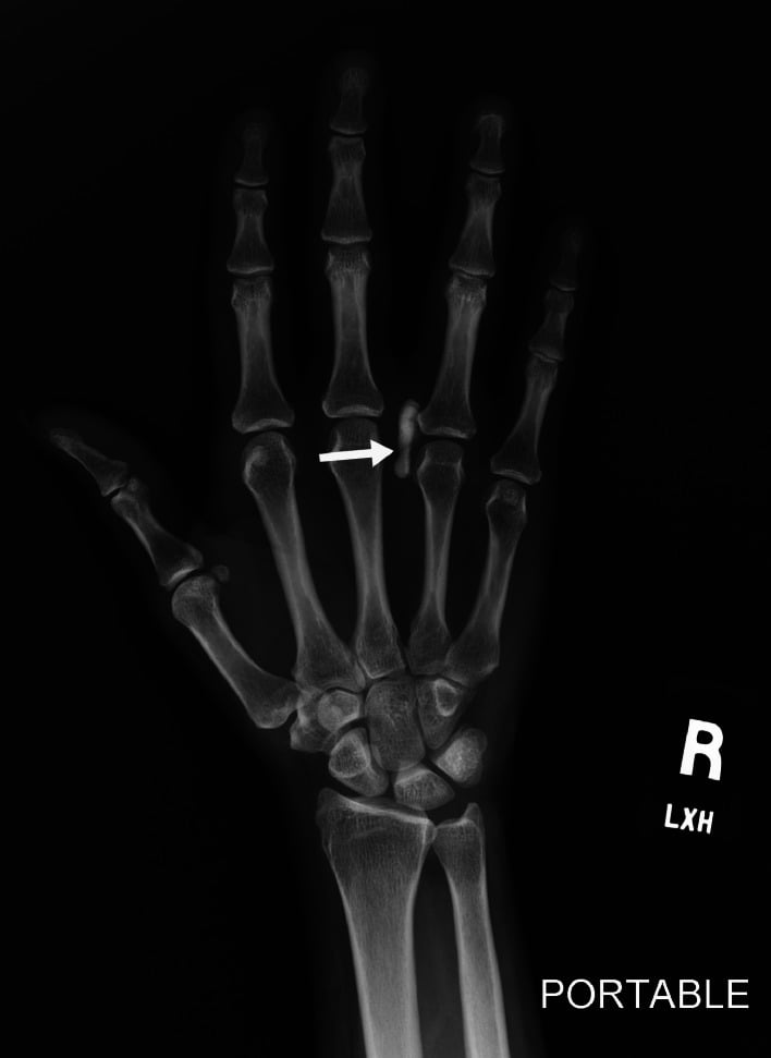 Radiograph of a right hand showing a linear periarticular calcific deposit, arrowed, between the third and fourth metacarpophalangeal joints