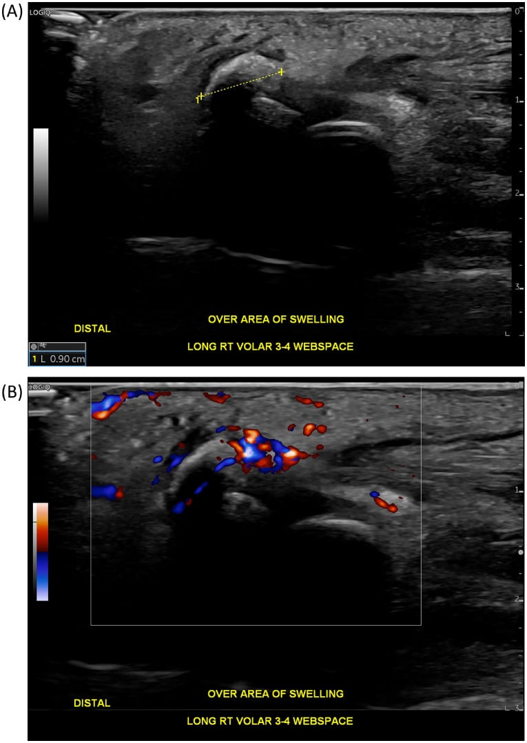 Longitudinal ultrasound over the right volar third-fourth web space: (A) a shadowing calcific focus measured at 0.90 cm, (B) colour Doppler flow around it