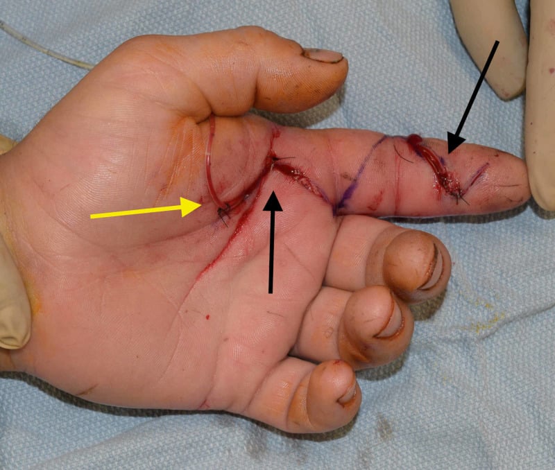 Index finger after closed flexor sheath irrigation with proximal and distal Bruner incisions and an irrigation catheter