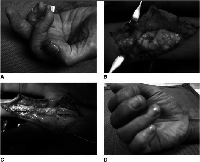 Four panels: (A) the hand before surgery, (B) operative exposure of white chalky tophaceous material, (C) the exposed tendons, (D) the hand closed into a fist