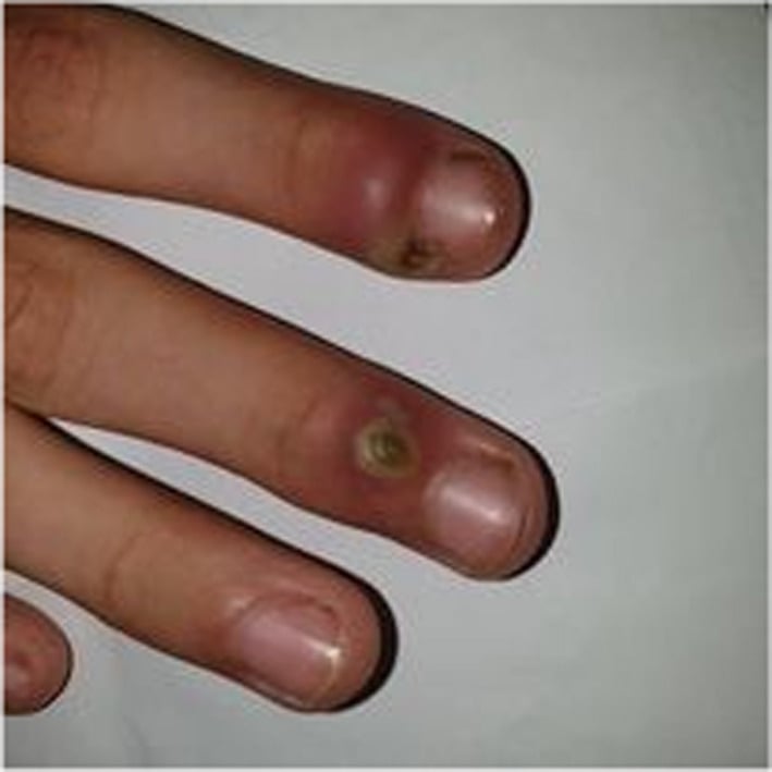 Dorsal view of several fingers, two with lesions near the nail: a pustule on an erythematous base and a crusted lesion, from herpetic whitlow