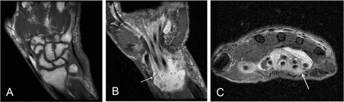 Three wrist MRI panels: (A) the carpus, (B) a long-axis image and (C) an axial image, the arrows marking tenosynovial fluid containing numerous low-signal rice bodies