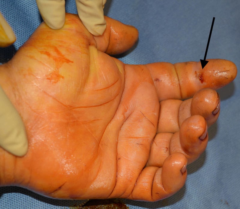 Palmar view of a hand with an arrow marking a small puncture wound on the volar index finger that caused flexor tenosynovitis