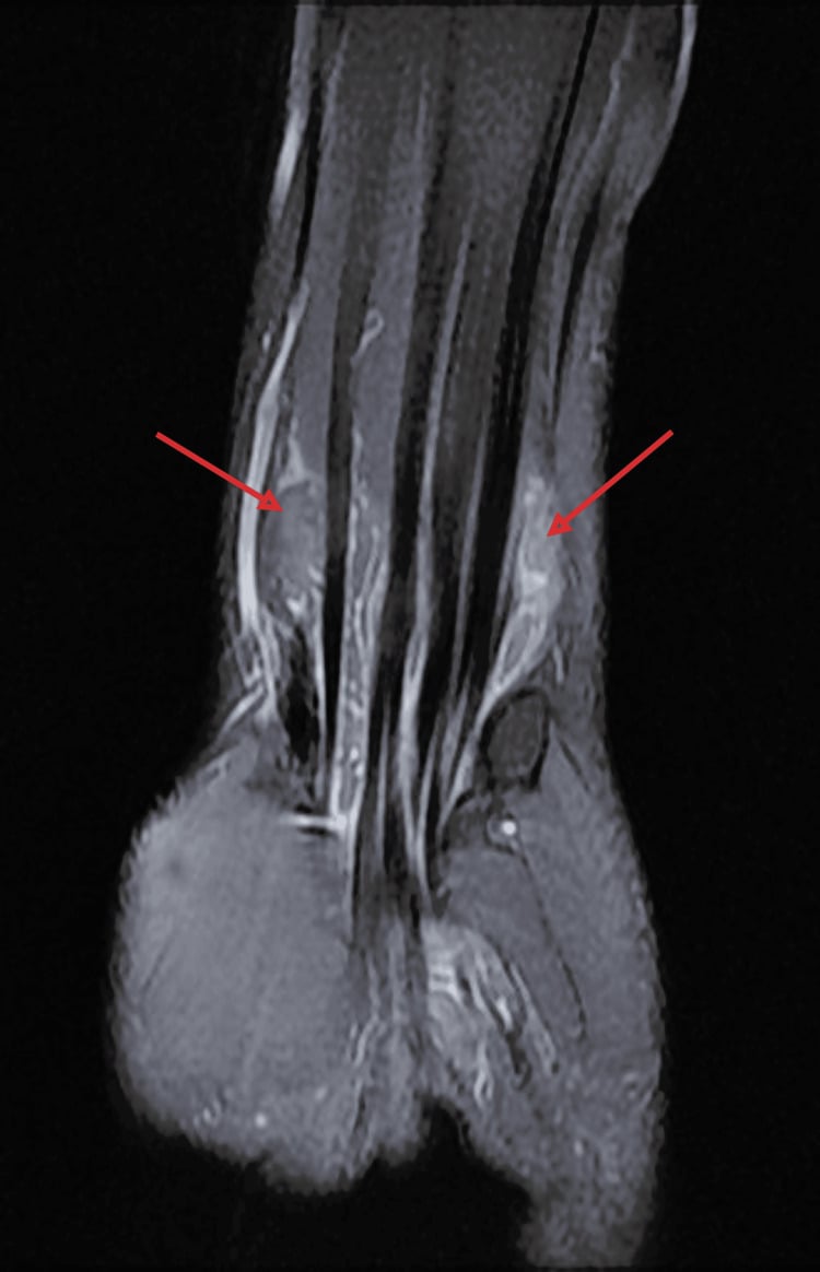 Coronal MRI of the distal forearm and wrist in tuberculous tenosynovitis, red arrows marking high-signal fluid along tendon sheaths on either side