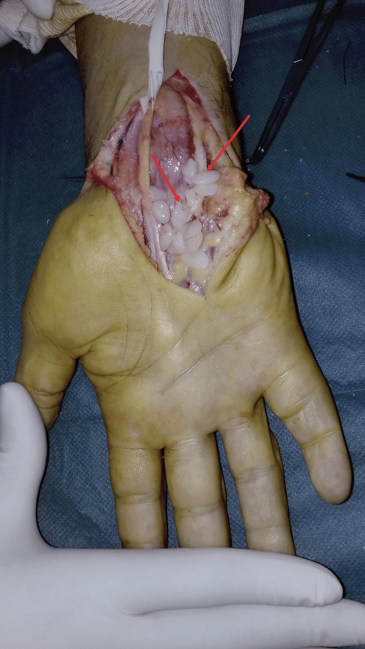 Operative view of numerous rice bodies, arrowed, within the volar wrist flexor tendon sheaths