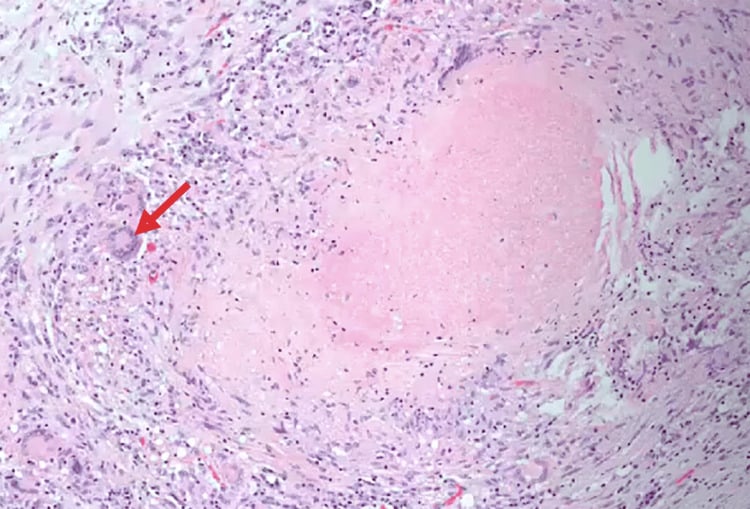 Histology of flexor tenosynovium showing a granuloma with central caseous necrosis and an arrowed multinucleated giant cell