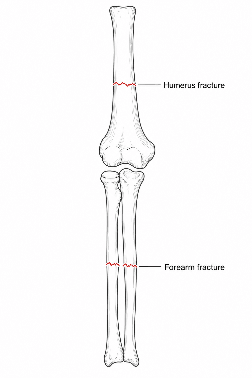Diagram of the arm bones with a fracture in the humerus above the elbow and a fracture in the forearm below it