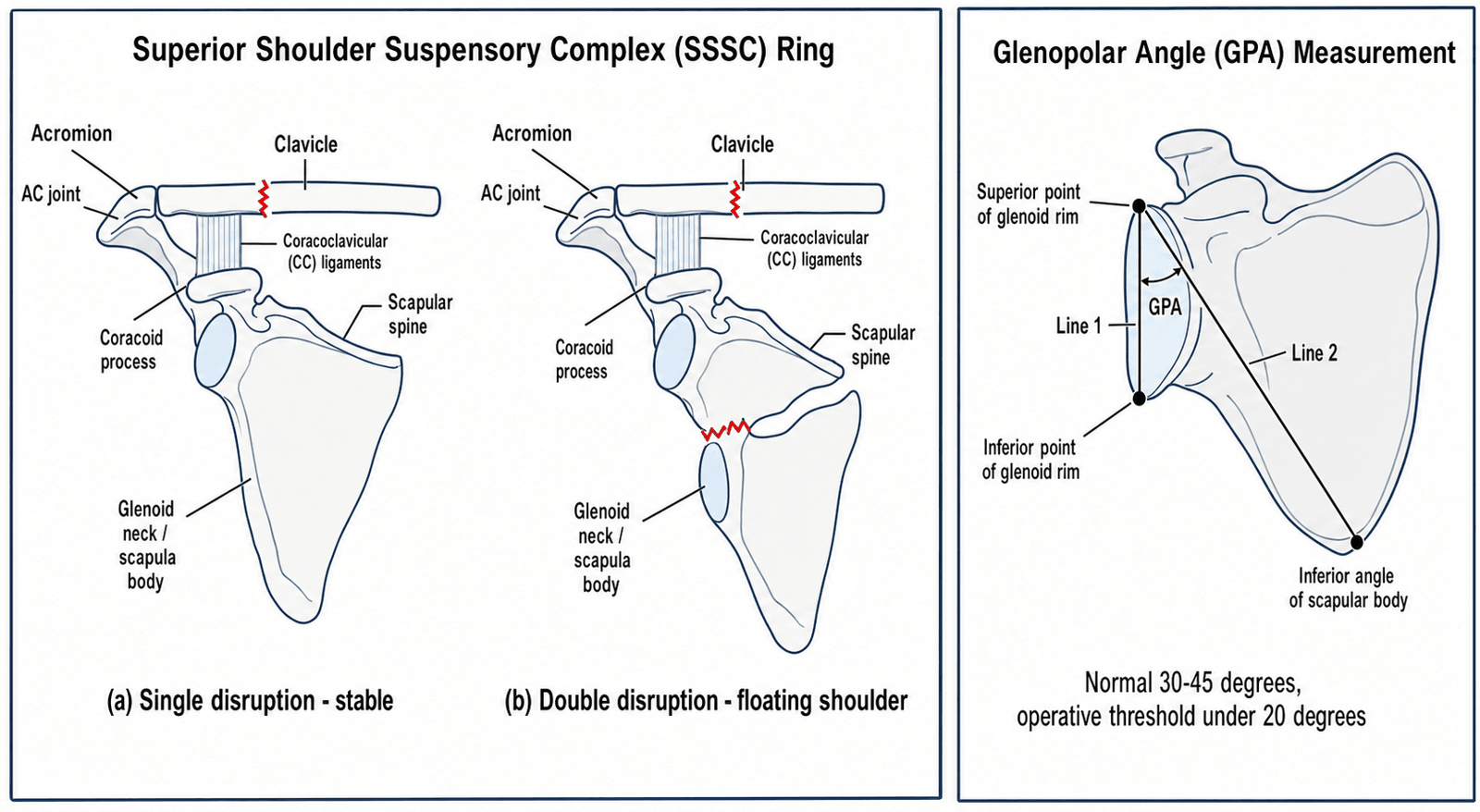 Two-panel schematic: the Superior Shoulder Suspensory Complex (SSSC) ring showing single (stable) versus double (floating shoulder) disruption, and the glenopolar angle (GPA) measurement technique with Line 1 through the glenoid poles and Line 2 to the inferior scapular angle.