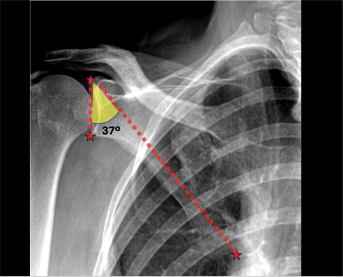 Glenopolar angle of 37 degrees measured on a shoulder radiograph, stars marking the superior and inferior glenoid poles and the inferior scapular angle