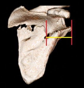 Three-dimensional CT of a fractured scapula with two parallel red vertical lines and a yellow horizontal line between them measuring medialisation