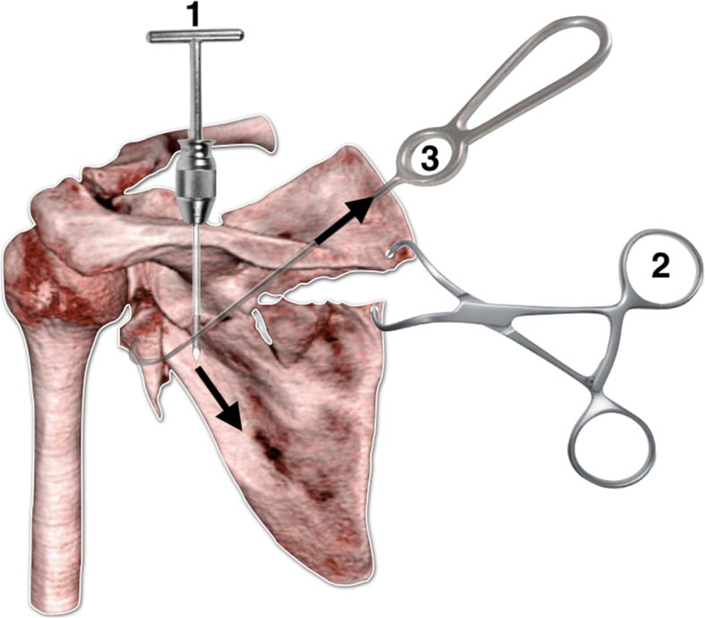 Reduction sequence for a displaced glenoid-neck and scapular-body fracture, drawn on a 3D CT with three numbered instruments