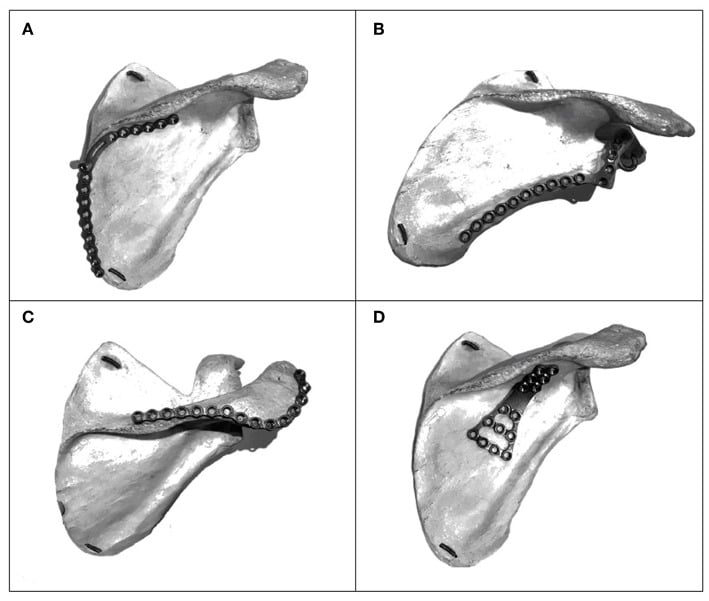 Anatomical plate options on a scapula model: a medial-border plate, a lateral-border plate, a plate along the spine to the acromion and a buttress plate for a floating fragment