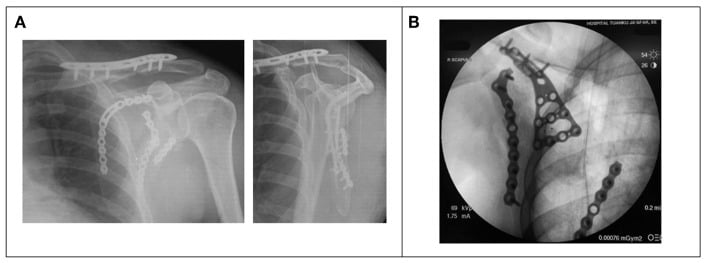 Postoperative radiographs of combined clavicle and scapular plating, and intraoperative fluoroscopy of a buttress plate controlling the floating scapular segment